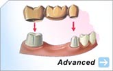 Bridges | Crowns | Gum and Bone Surgery | Dental Implants | Root Canals | Tooth Extractions | Wisdom Teeth