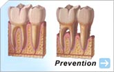 Adult Care | Baby Bottle Tooth Decay | Mouth Guards | Preventative Ages 1-5 | Preventative Ages 6-18 | Sealants